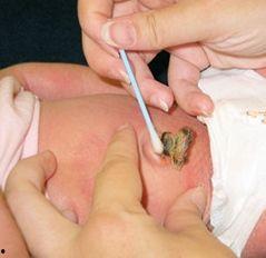 新生儿涂碘伏肚脐视频,碘伏涂抹操作视频详解