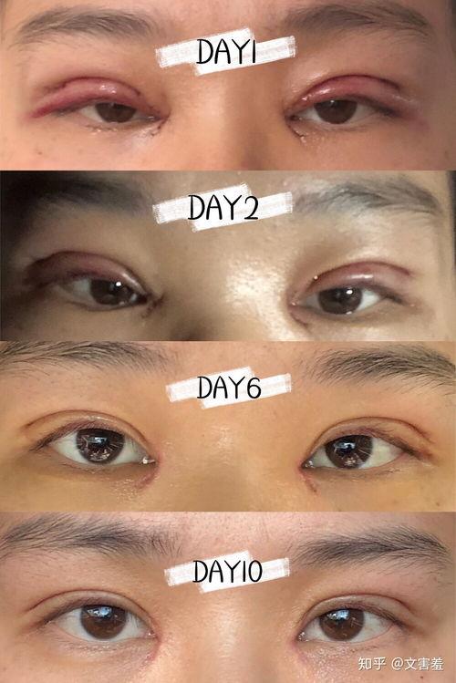 双眼皮手术视频全切,专业视角下的美丽蜕变
